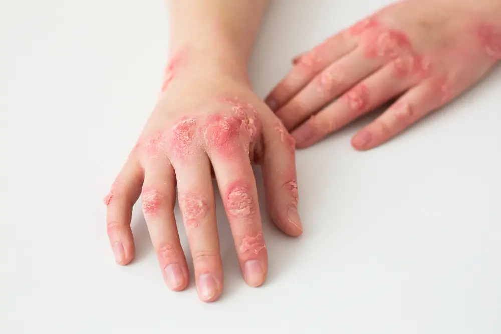 Eczema Treatment​ Clovis